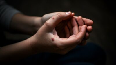 Dermatolog upozorava: Ne zanemarujte ove signale na koži – mogu ukazivati na ozbiljne bolesti